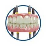 восстановление зубов всей челюсти под ключ в клинике ТоталСтом